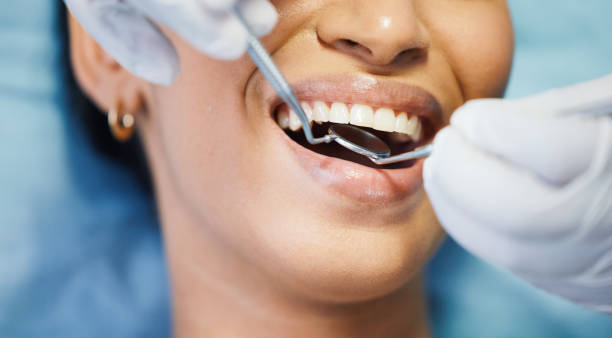 Best Emergency Wisdom Teeth Removal in Baltimore, OH